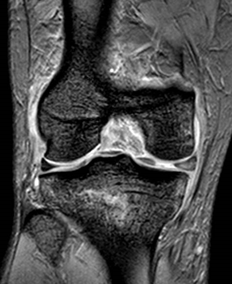 Puedo Tener Roto El Ligamento Cruzado Posterior S Ntomas Relevantes