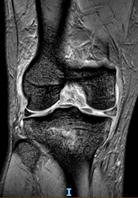 ligamento cruzado posterior