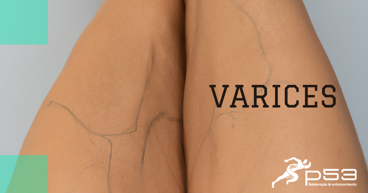 varices